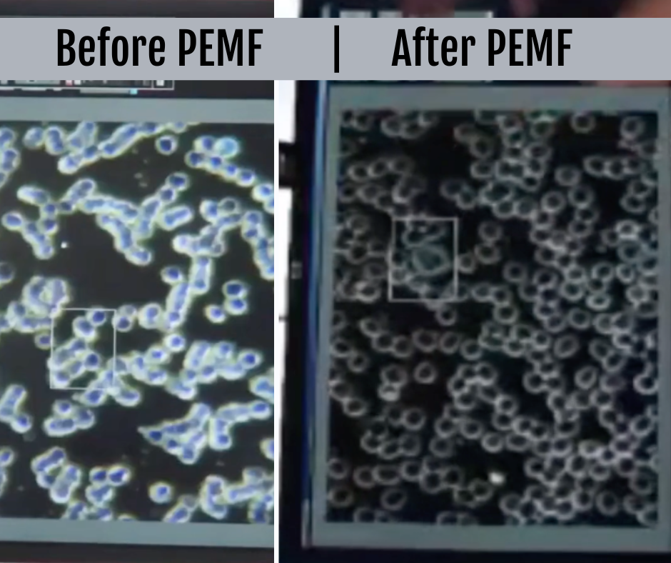 Red Blood Cells before and after PEMF therapy