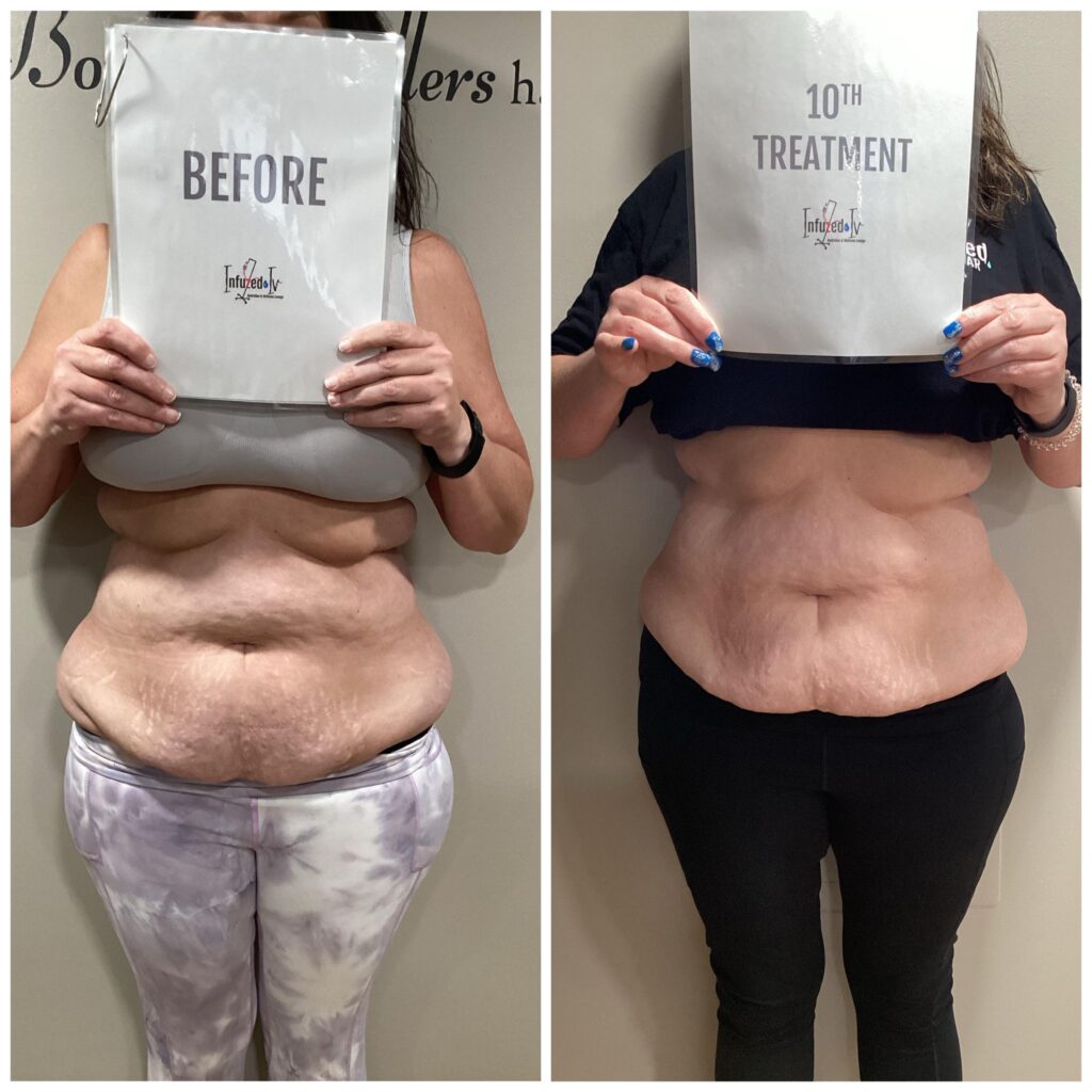 Weight Loss At Infuzed with semaglutide and tirzepatide